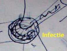 22.05.2007: Kinderarts Sonja Faries maakte deze tekening om haar diagnose van Diana's ontsteking te verduidelijken. Klik voor groter.